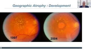 Lecture: Dry AgeRelated Macular Degeneration (AMD) Update: New Therapies