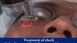 eCO2 Premium Treatment