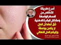 إذا أردتم اسرع طريقة للتخلص من المسام الواسعة والبشرة الدهنيةهنا الحل النهائي للتخلص من المسام واسعة 