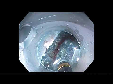 Tools   Techniques, Use of Novel Dual Action for Closure of Complex Defects