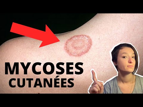 Vidéo: 3 façons de traiter une infection fongique de la peau