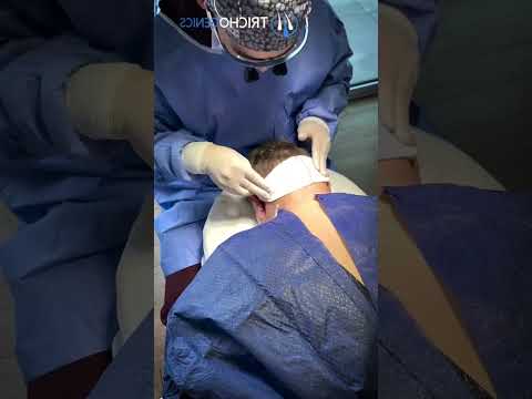 جراحی کاشت ابرو آیا ارزشش را دارد کاشت ابرو کاشت مو ابرو مو