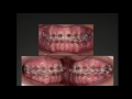 Colagem em ortodontia - PROF. DR. PEDRO ANDRADE JR.