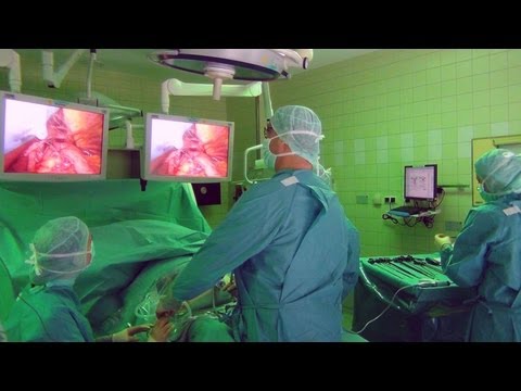 Video: Zwerchfellhernie - Hiatushernie: Behandlung Und Operation