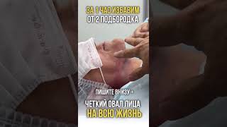 Убираем второй подбородок в нашей клинике 🫰🏻✨
