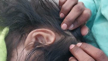 Nitpicking ASMR  video 207   #kuto #piolho #nitpicking #asmr  ( few noises in background )