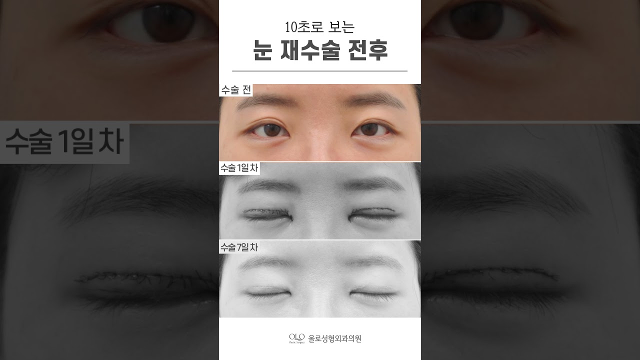 [奧羅整形外科診所] #初眼 手術後，眼睛更加顯得無神，透過 #眼部重修 改善 🙌 #無疤痕~ #shorts