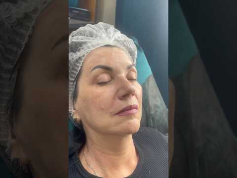 Как помолодела моя пациентка #косметологростов #beforeandafter #косметологмосква