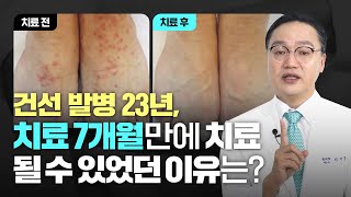 오래된 건선치료는 접근방법부터 달라야 합니다.