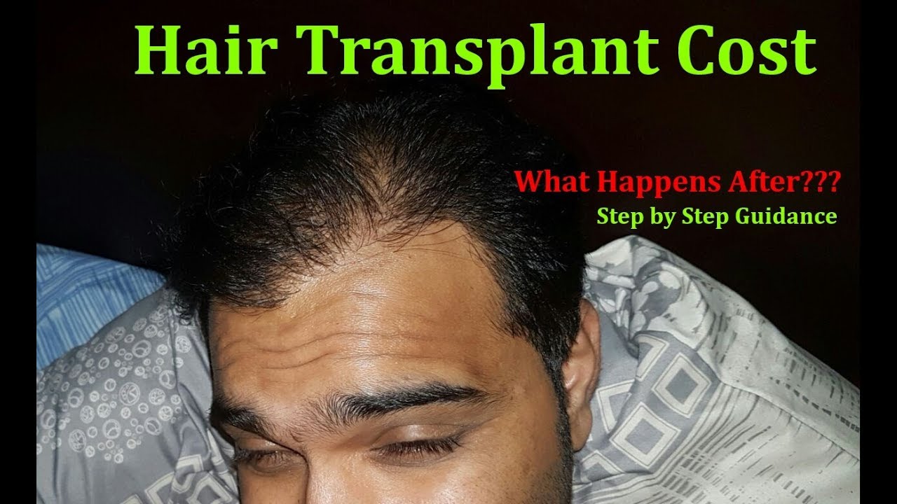 Biofibre Hair Transplant l Biofibre Hair Implant cost Mumbai, India l  Synthetic Hair Transplant - YouTube