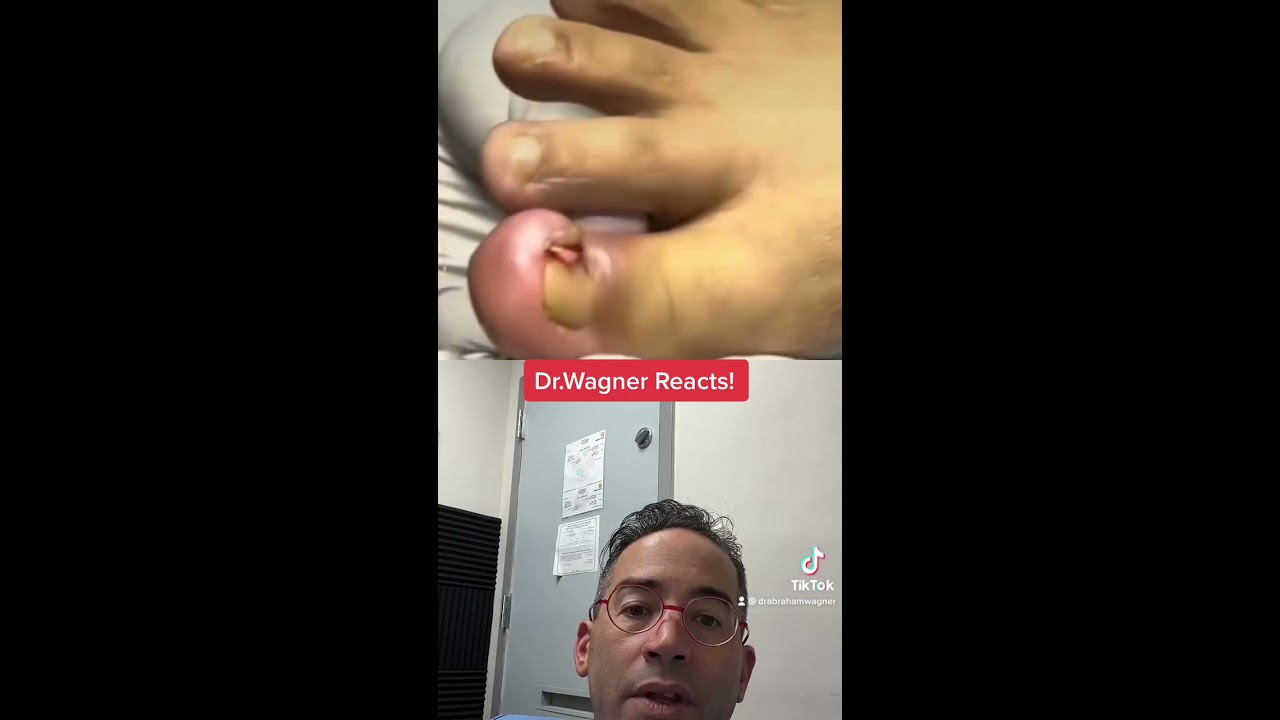 ANGRY INGROWN TOENAIL Shorts Ingrowntoenail