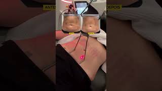 Flacidez abdominal te incomoda?
