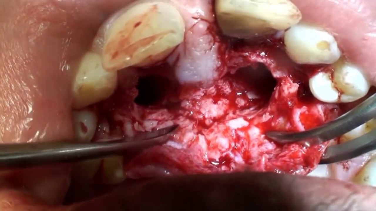 ผ่าฟันเขี้ยวคุด Impacted Canines Surgery