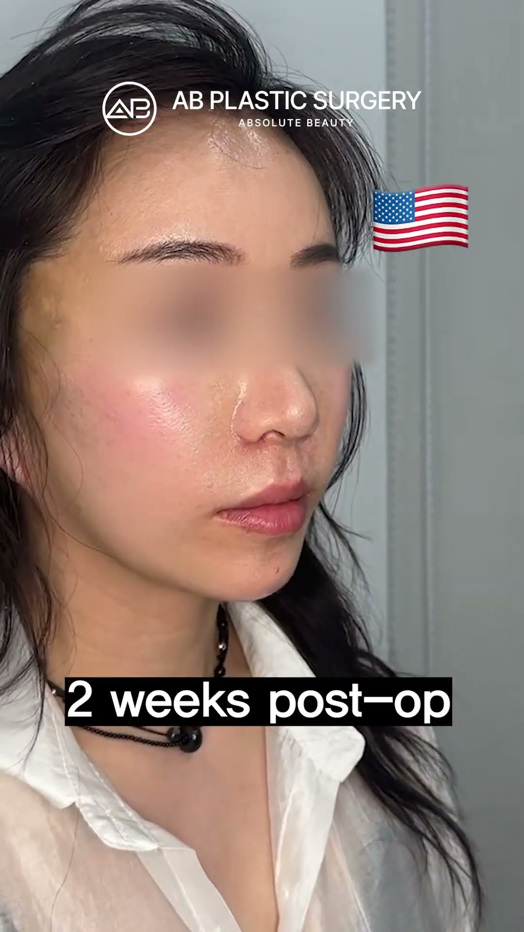 Natural Facelift Transformation #shorts