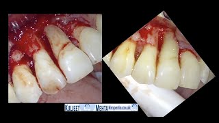 Periodontal Surgery with GTR-UR1,2,3. by Dr Kuljeet Singh Mehta-Periodontist 3,490 views 1 year ago 17 minutes