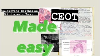 Ceot Calcifying Epithelial Odontogenic Tumour 4Min