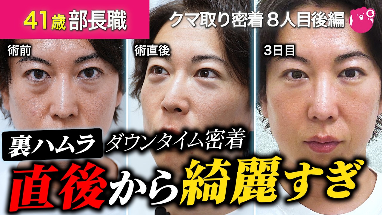 【裏ハムラ】40代男性のクマ取りダウンタイム1ヶ月後まで全て公開！直後から感動の仕上がり【クマ取り密着8人目後編】