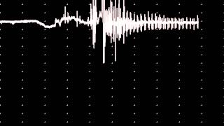 EMG increased insertional activity
