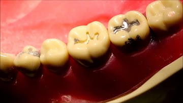 Class 1 Amalgam Preparation on #19