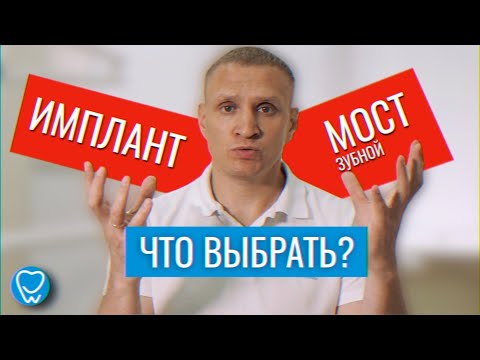 Имплант или зубной мостик. Что лучше выбрать? Имплантация зубов. Мост зубной | Доктор Коннов