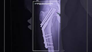 Hip Preservation Surgery Successfully Performed | Saving the Natural Hip Joint
