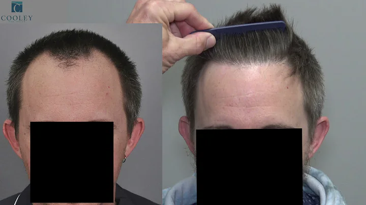 Absolutely Unrivalled Naturalness - Hairline Hair ...