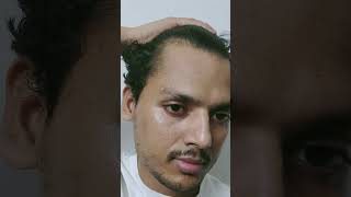 Bald to Hair Transformation Naturally | Bald Head Hair Growth | Traya Hair Review
