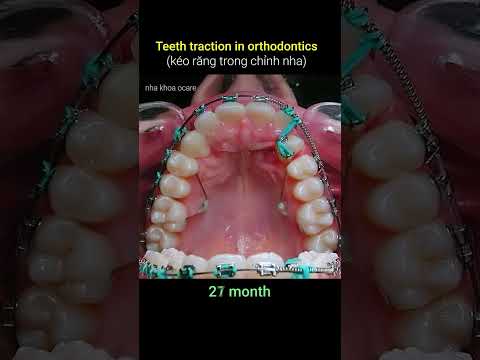 Video: Saxta Ortodontik Brace necə hazırlanır: 11 addım