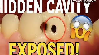 Cavity Between Anterior Teeth treatment