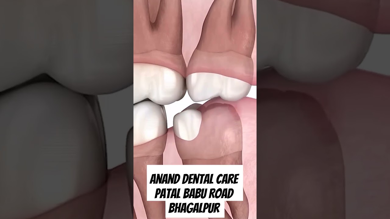 Wisdom tooth extraction | last molar extraction | third molar disimpaction | अकल दांत निकालना |