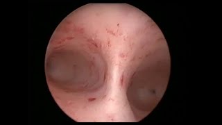 Hysteroscopic Septum Resection