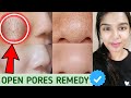 No More Large Open pores/Bumps/Blackheads/Whiteheads/clogged pores| How to get rid of open pores?