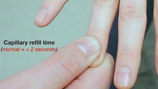 Capillary Nail Refill