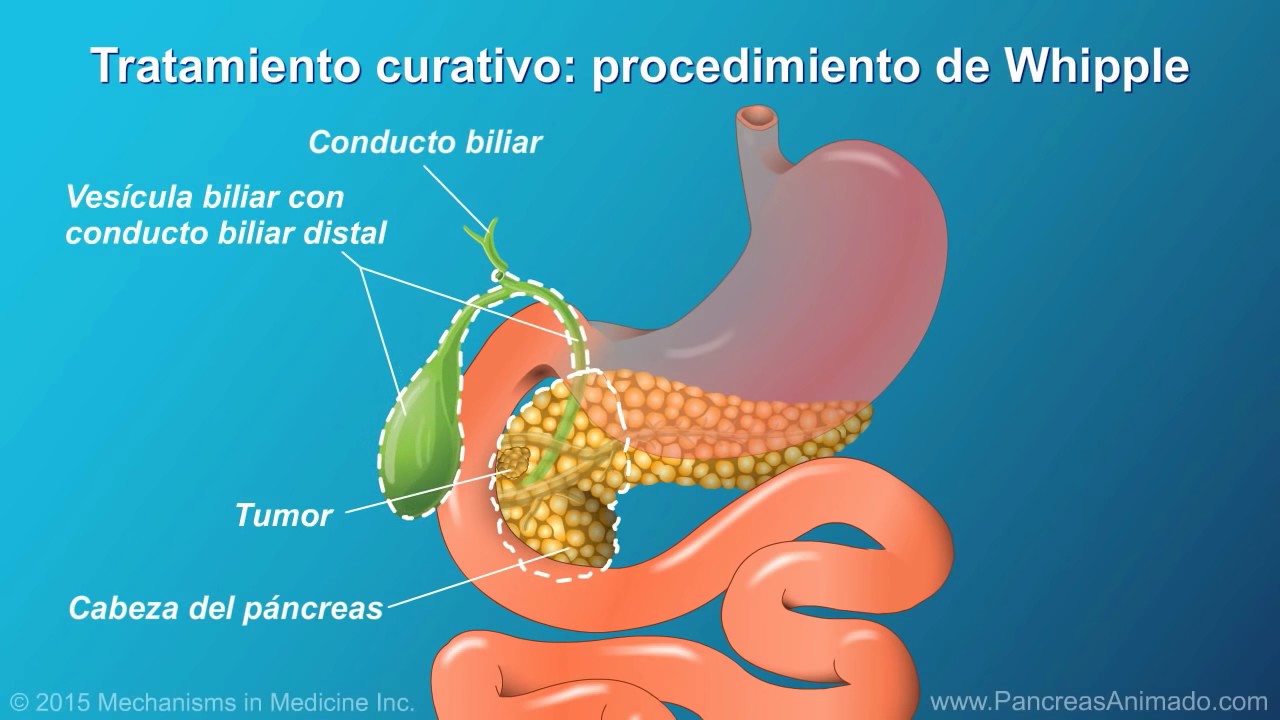 Dieta despues de una operacion de vesicula