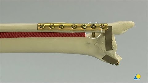 Tibia and Fibula - Malleolar Fracture (44C)- ORIF Using an LCP One-Third Tubular Plate & a Lag Screw