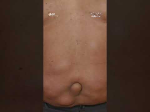 يخاطر بحياته لإزالة الأورام - الجزء الأول