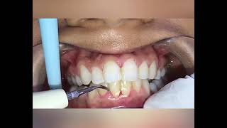 Scaling Teeth