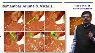 ERCP Masterclass - Tips And Tricks of Selective Biliary Cannulation