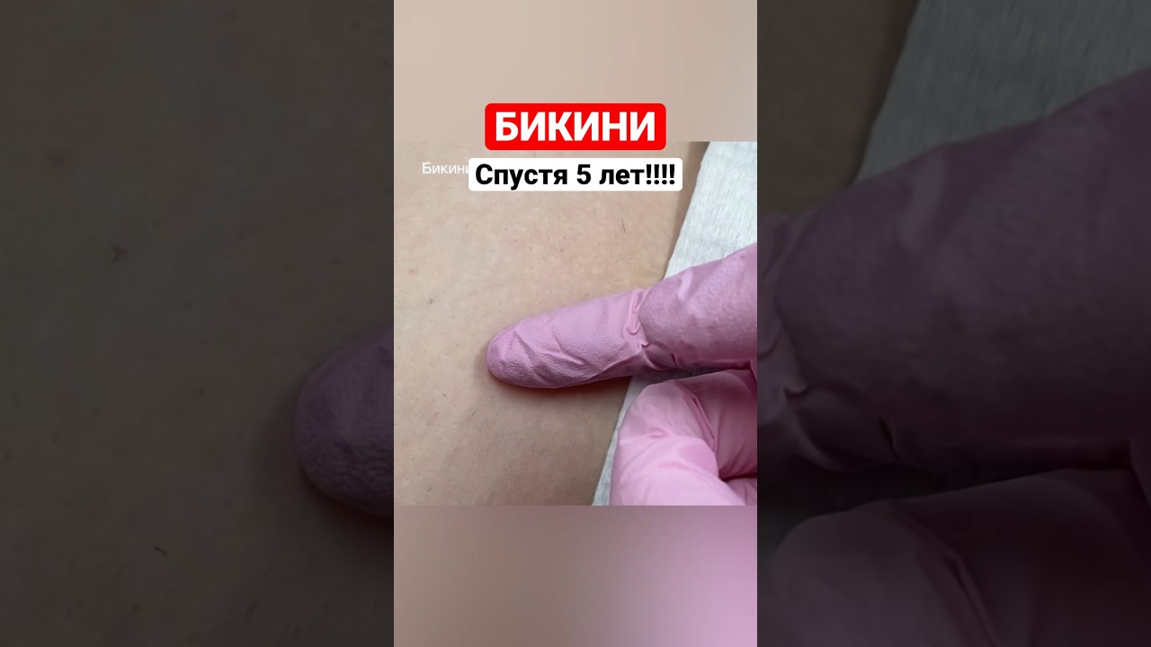 Электроэпиляция бикини. Результат спустя 5 лет!!! #электроэпиляция #обучениеэлектроэпиляции
