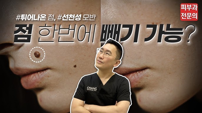 피부과 의사가 말하는 점 빼기 전 알아야 할 모든 것 (Feat. 편평사마귀) | 점 빼는 거 많이 아픈가요? [1부] - Youtube