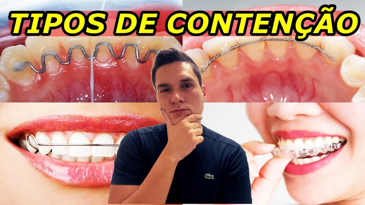 TIPOS DE CONTENÇÂO ORTODÔNTICA | VANTAGENS E DESVANTAGENS | QUAL A MELHOR?