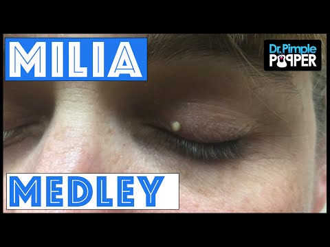 A Dr Pimple Popper Milia Medley