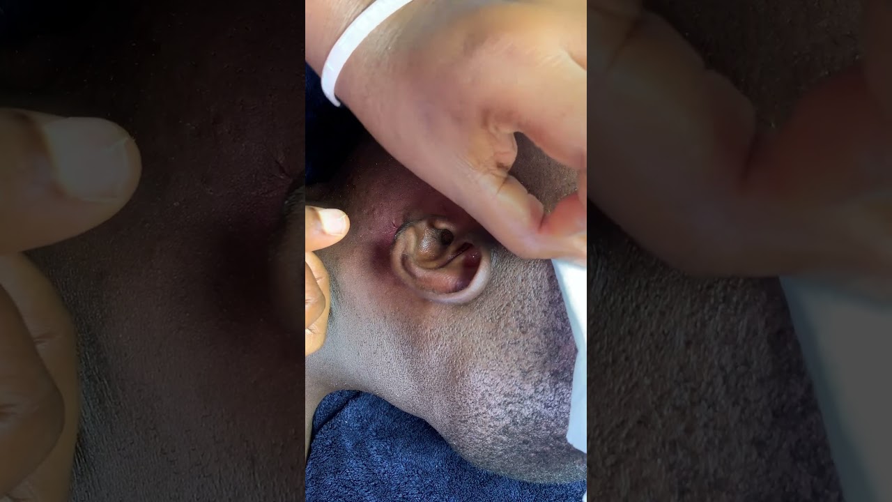 Attentive Nitpicking 