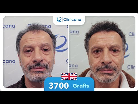 Jimmy’s hair transplant