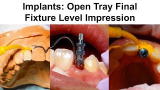 Famous 7. Implants: Open Tray Final  Fixture Level Impression Profile