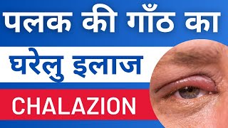 पलक की गाँठ (Chalazion) का घरेलु इलाज