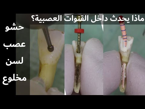فيديو: هل rct جيد للأسنان؟