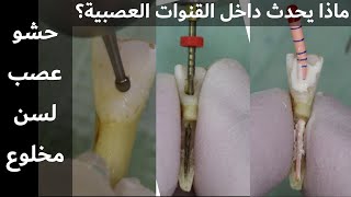 خطوات حشو العصب للأسنان الأمامية وماذا يحدث داخل القنوات العصبية ؟Root Canal Treatment for teeth screenshot 3