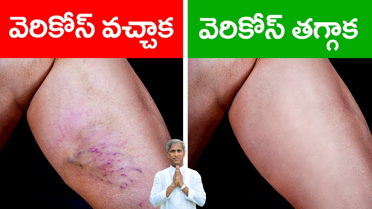 Best Varicose Veins Treatment | How to Get Rid Varicose Veins | Dr Manthena Satyanarayana Raju