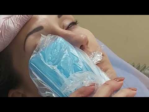 Филлер teosyal для заполнения морщин в области глаз.